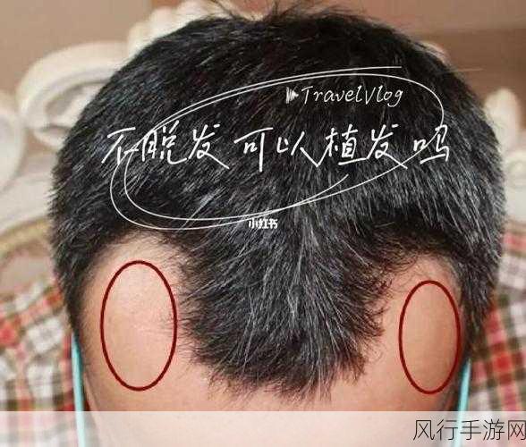 探究植发所用毛发之谜